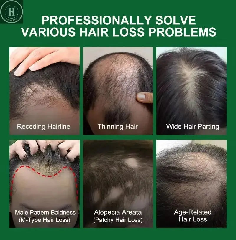 Fast Hair Growth Serum Spray Anti Hair Loss Prevent Baldness Scalp Treatment Repair Roots Beauty Health Hair Care For Men Women HALALZEN