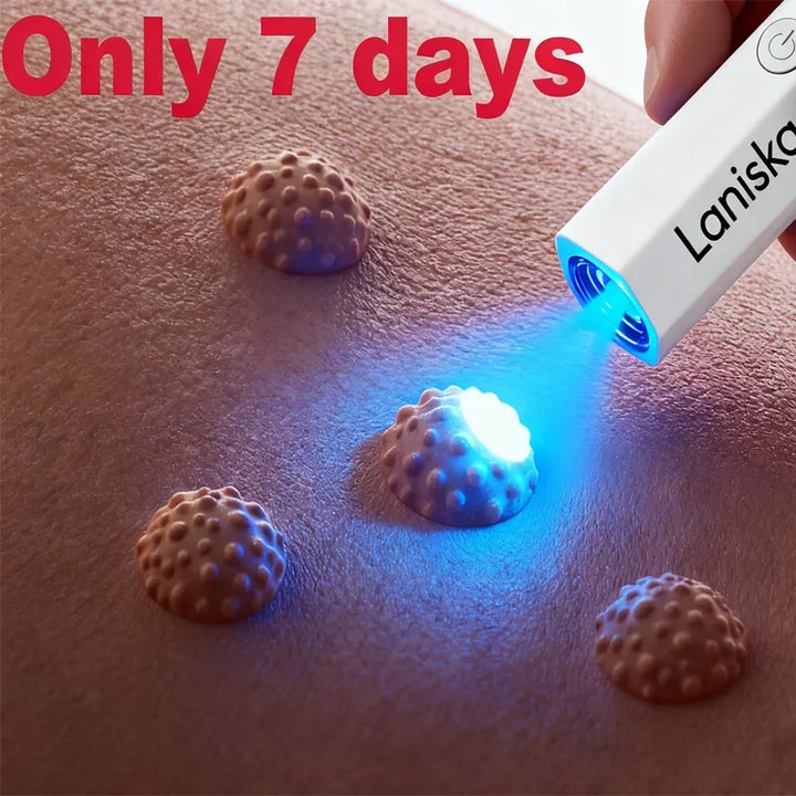 The latest generation of blue light wart removal pen quickly eliminates warts.